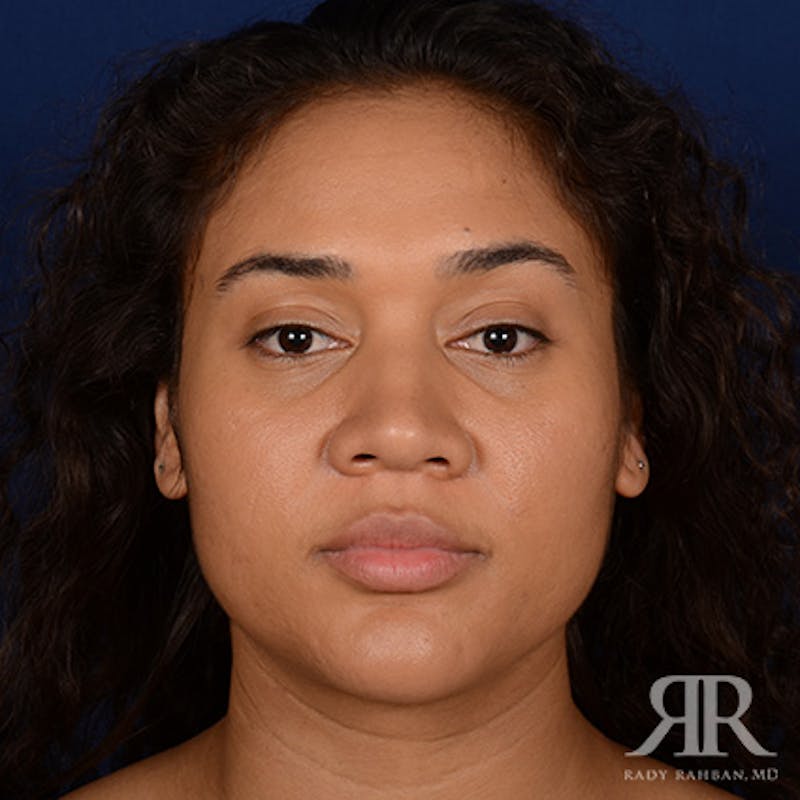 Female Rhinoplasty Before & After Gallery - Patient 323391 - Image 1