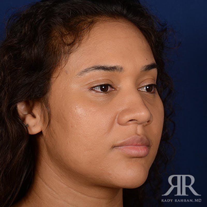 Female Rhinoplasty Before & After Gallery - Patient 323391 - Image 3