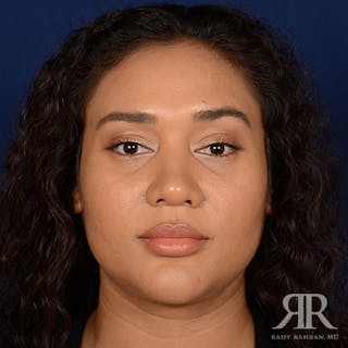 Female Rhinoplasty Before & After Gallery - Patient 323391 - Image 2