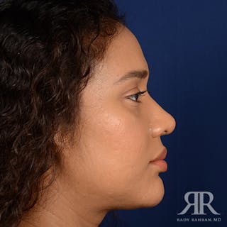 Female Rhinoplasty Before & After Gallery - Patient 323391 - Image 6