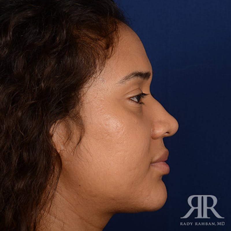 Female Rhinoplasty Before & After Gallery - Patient 323391 - Image 5