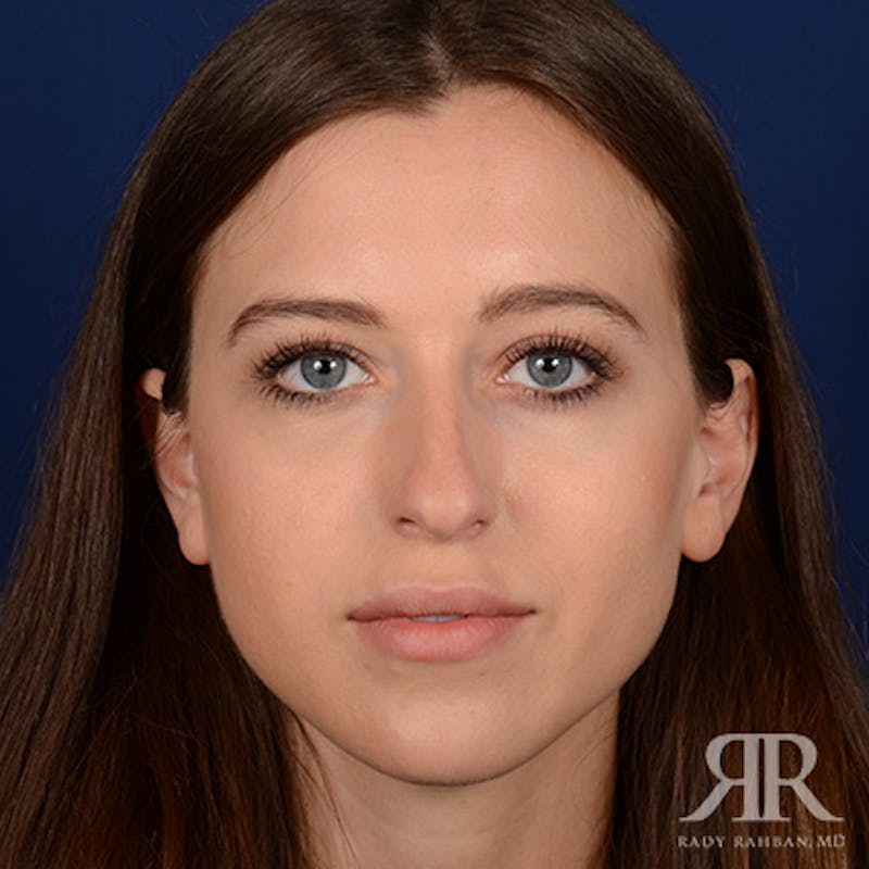 Female Rhinoplasty Before & After Gallery - Patient 289103 - Image 1