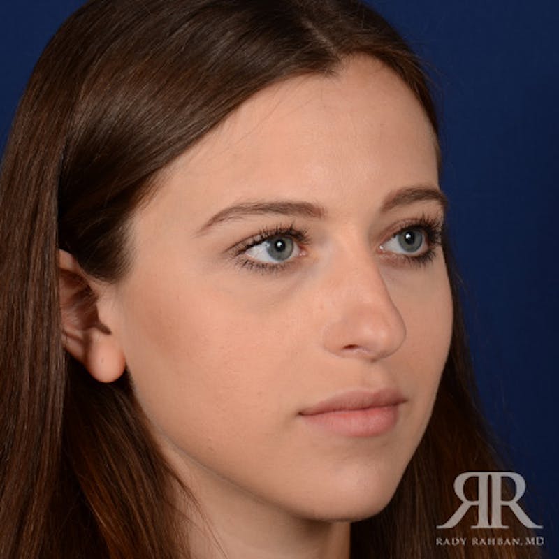 Female Rhinoplasty Before & After Gallery - Patient 289103 - Image 3