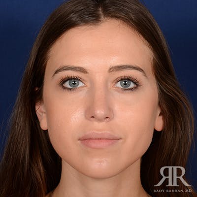 Female Rhinoplasty Before & After Gallery - Patient 289103 - Image 2