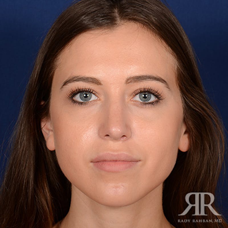Female Rhinoplasty Before & After Gallery - Patient 289103 - Image 2