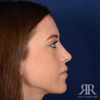 Female Rhinoplasty Before & After Gallery - Patient 289103 - Image 6