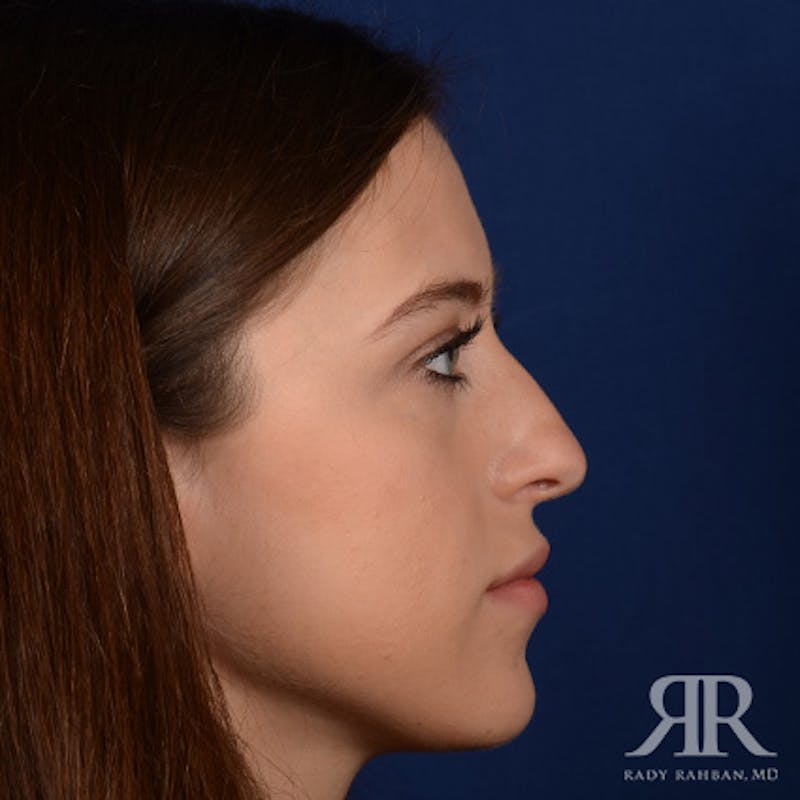 Female Rhinoplasty Before & After Gallery - Patient 289103 - Image 5