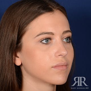 Female Rhinoplasty Before & After Gallery - Patient 289103 - Image 4