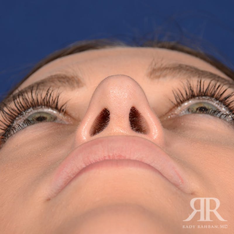 Female Rhinoplasty Before & After Gallery - Patient 289103 - Image 8