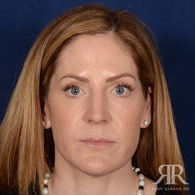 Female Rhinoplasty Before & After Gallery - Patient 399181 - Image 1