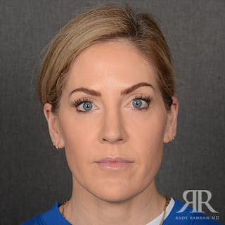 Female Rhinoplasty Before & After Gallery - Patient 399181 - Image 2