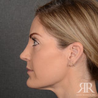 Female Rhinoplasty Before & After Gallery - Patient 399181 - Image 6