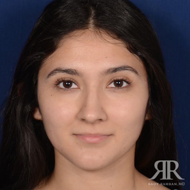 Female Rhinoplasty Before & After Gallery - Patient 428653 - Image 1