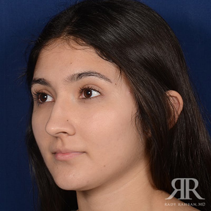 Female Rhinoplasty Before & After Gallery - Patient 428653 - Image 3