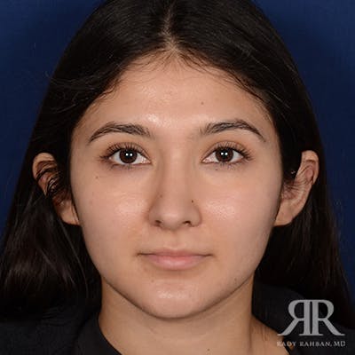 Female Rhinoplasty Before & After Gallery - Patient 428653 - Image 2