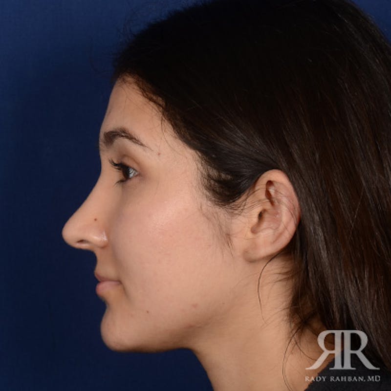 Female Rhinoplasty Before & After Gallery - Patient 428653 - Image 6