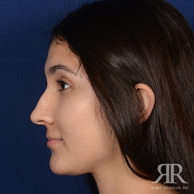 Female Rhinoplasty Before & After Gallery - Patient 428653 - Image 5