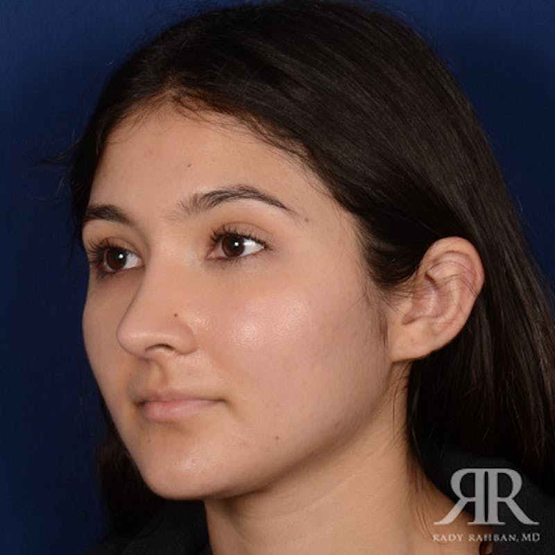 Female Rhinoplasty Before & After Gallery - Patient 428653 - Image 4