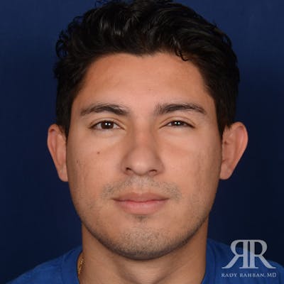 Male Rhinoplasty Before & After Gallery - Patient 247287 - Image 1