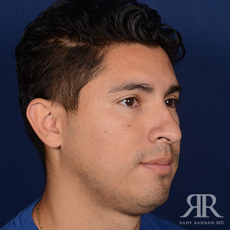 Male Rhinoplasty Before & After Gallery - Patient 247287 - Image 3