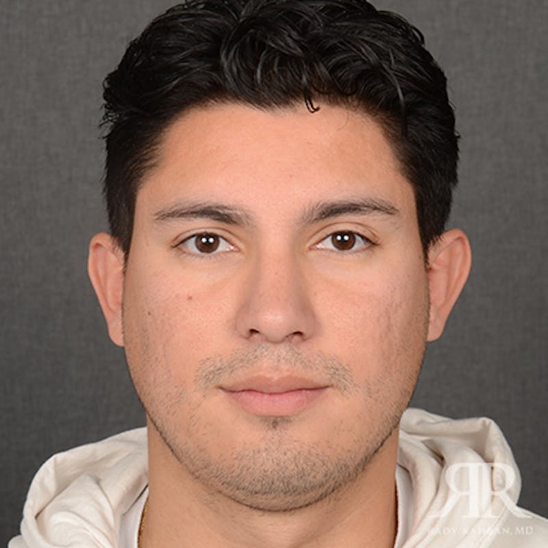 Male Rhinoplasty Before & After Gallery - Patient 247287 - Image 2