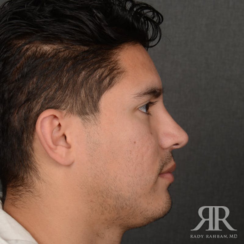 Male Rhinoplasty Before & After Gallery - Patient 247287 - Image 6