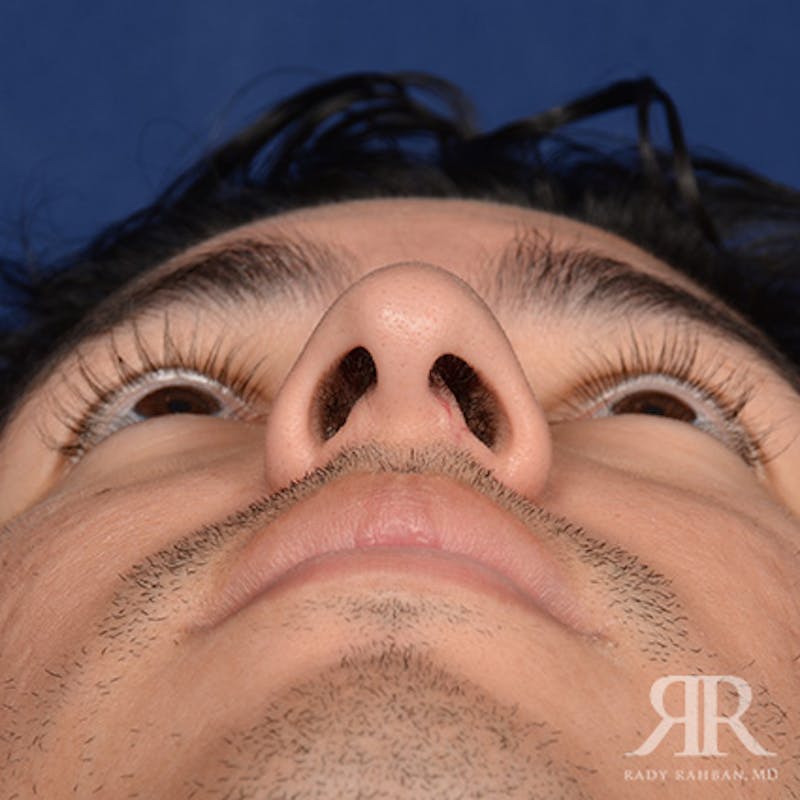 Male Rhinoplasty Before & After Gallery - Patient 247287 - Image 7