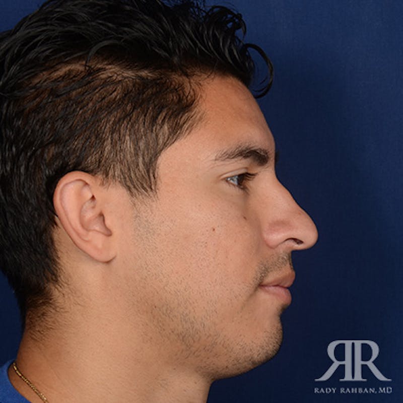 Male Rhinoplasty Before & After Gallery - Patient 247287 - Image 5
