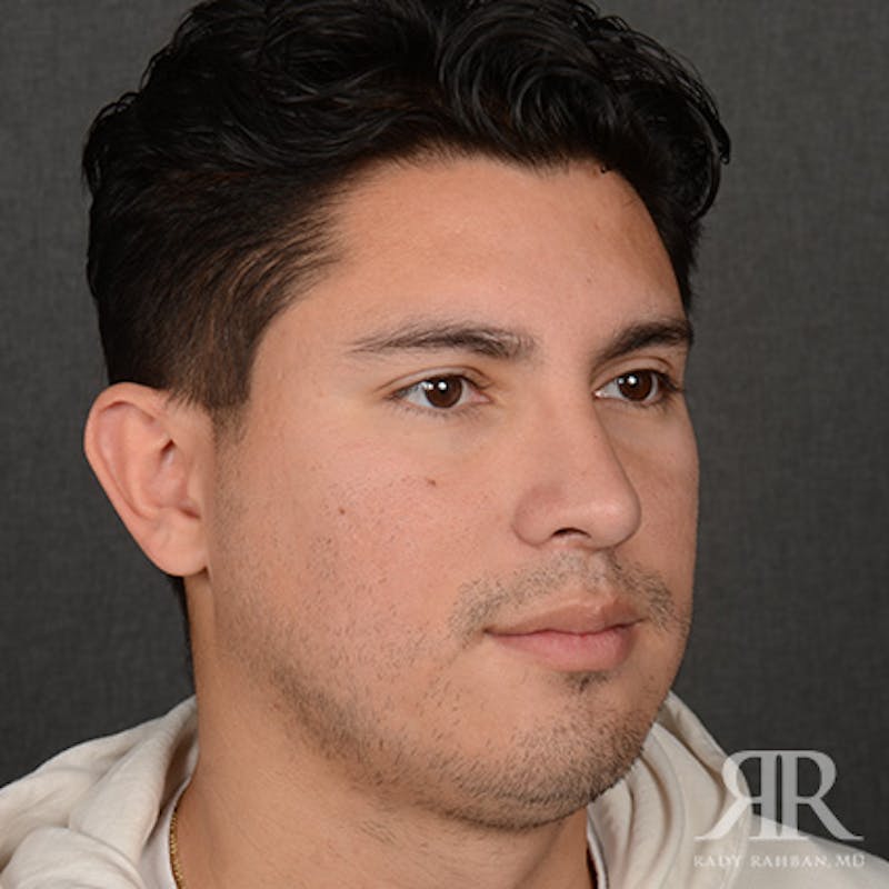 Male Rhinoplasty Before & After Gallery - Patient 247287 - Image 4