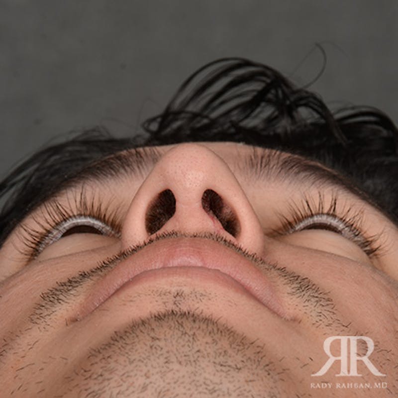 Male Rhinoplasty Before & After Gallery - Patient 247287 - Image 8