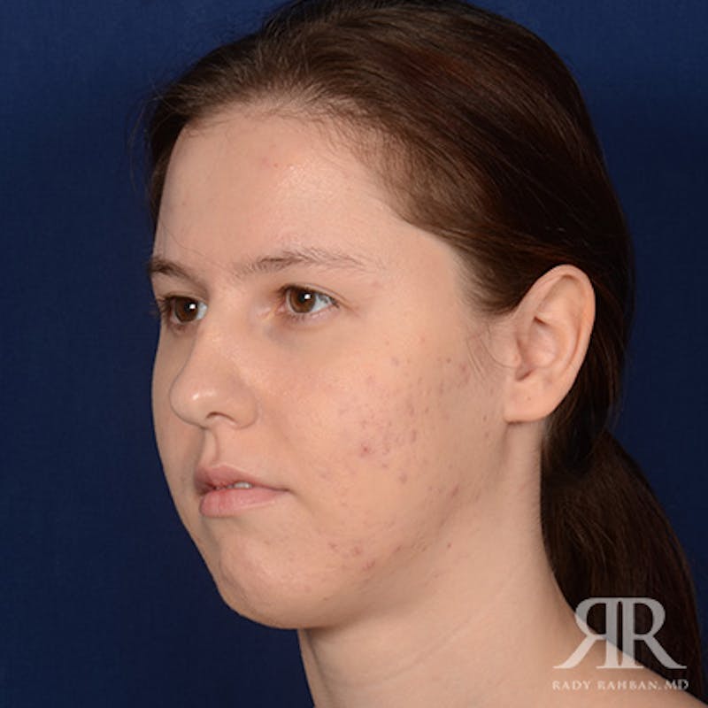 Female Rhinoplasty Before & After Gallery - Patient 342016 - Image 3