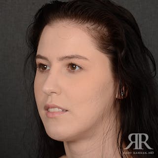Female Rhinoplasty Before & After Gallery - Patient 342016 - Image 4