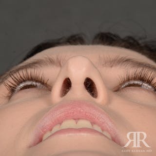 Female Rhinoplasty Before & After Gallery - Patient 342016 - Image 8