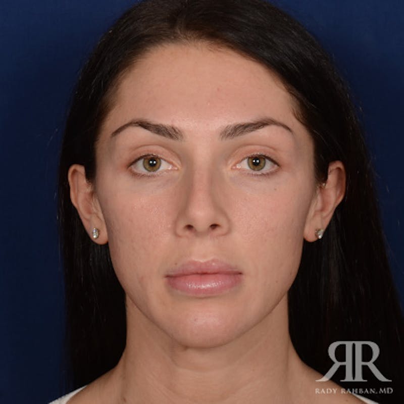 Female Rhinoplasty Before & After Gallery - Patient 622061 - Image 1