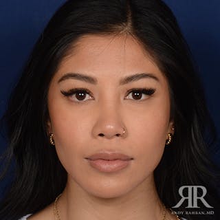 Female Rhinoplasty Before & After Gallery - Patient 428301 - Image 2