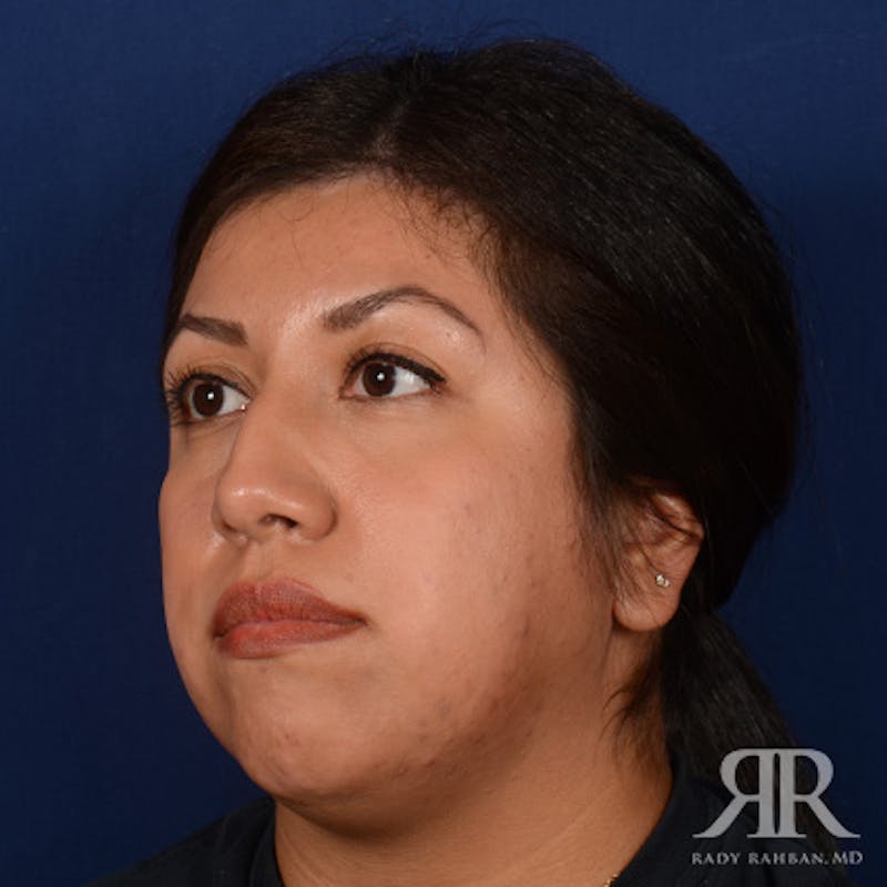 Female Rhinoplasty Before & After Gallery - Patient 394425 - Image 3