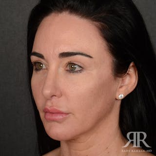 Female Rhinoplasty Before & After Gallery - Patient 255539 - Image 4