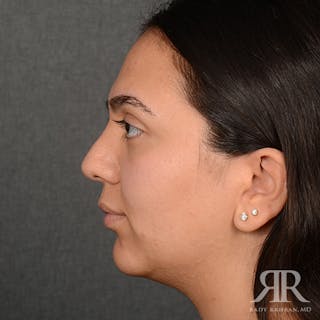 Female Rhinoplasty Before & After Gallery - Patient 287540 - Image 6