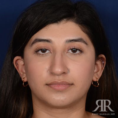 Female Rhinoplasty Before & After Gallery - Patient 187268 - Image 1