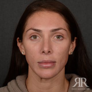 Female Rhinoplasty Before & After Gallery - Patient 622061 - Image 2