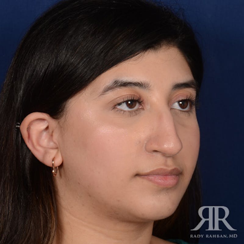 Female Rhinoplasty Before & After Gallery - Patient 187268 - Image 3