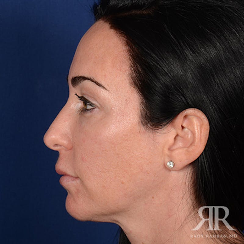 Female Rhinoplasty Before & After Gallery - Patient 255539 - Image 5