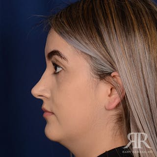 Female Rhinoplasty Before & After Gallery - Patient 277145 - Image 6