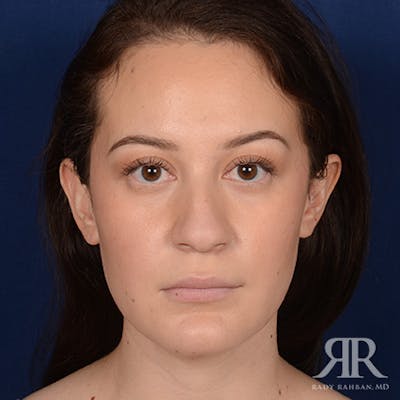 Female Rhinoplasty Before & After Gallery - Patient 302916 - Image 1