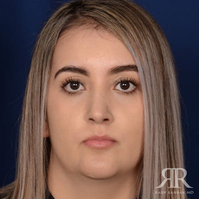 Female Rhinoplasty Before & After Gallery - Patient 277145 - Image 2