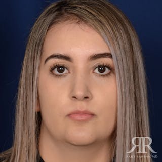 Female Rhinoplasty Before & After Gallery - Patient 277145 - Image 2