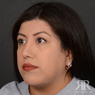 Female Rhinoplasty Before & After Gallery - Patient 394425 - Image 4