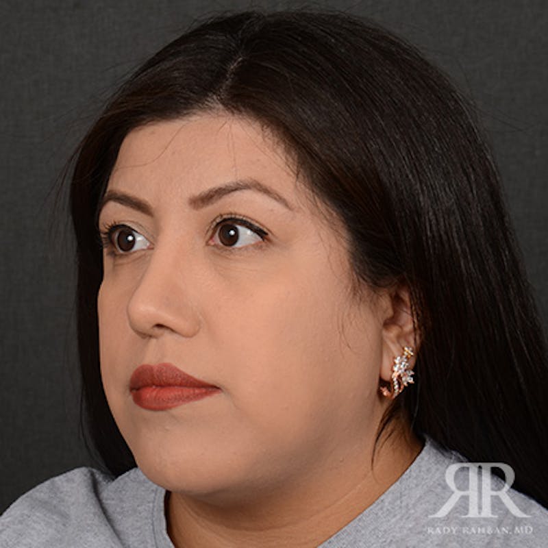 Female Rhinoplasty Before & After Gallery - Patient 394425 - Image 4