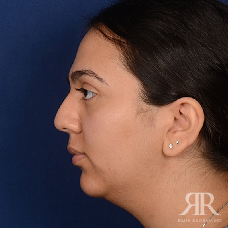 Female Rhinoplasty Before & After Gallery - Patient 287540 - Image 5