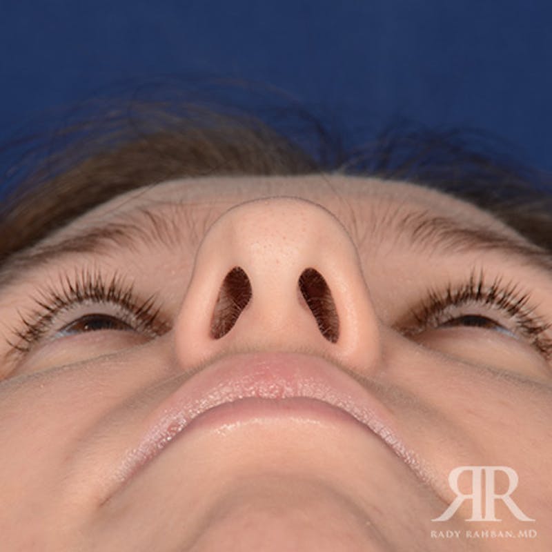 Female Rhinoplasty Before & After Gallery - Patient 342016 - Image 7